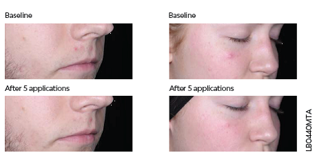 Acne Spot Treatment before and after